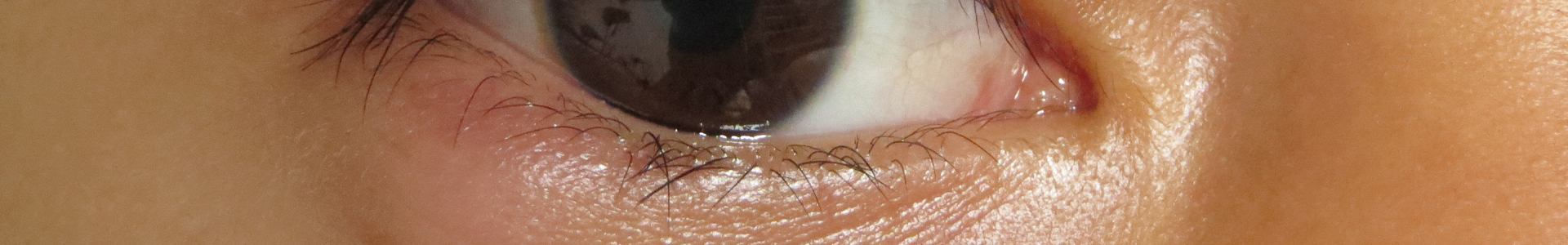Papil Ödem (Optik Disk Ödemi) Nedir?