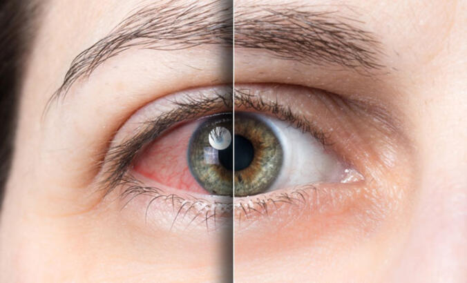 Göz Kızarıklığı Neden Olur? Ne İyi Gelir? Nasıl Geçer?